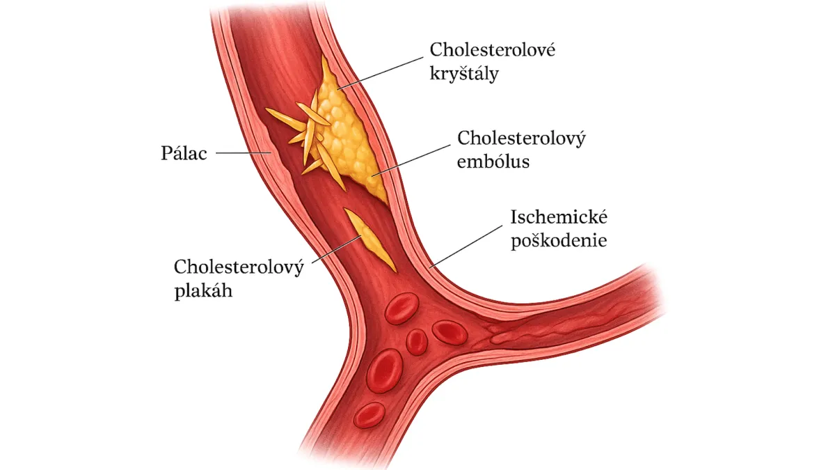 Cholesterolová embólizácia