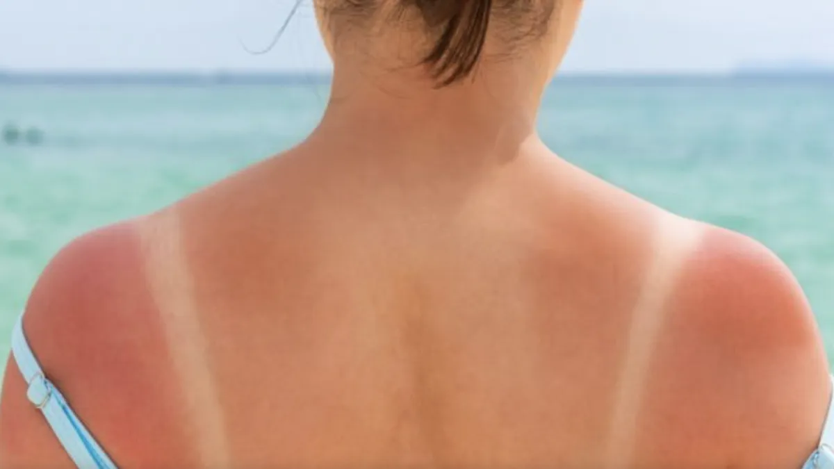 Dermatitis solaris