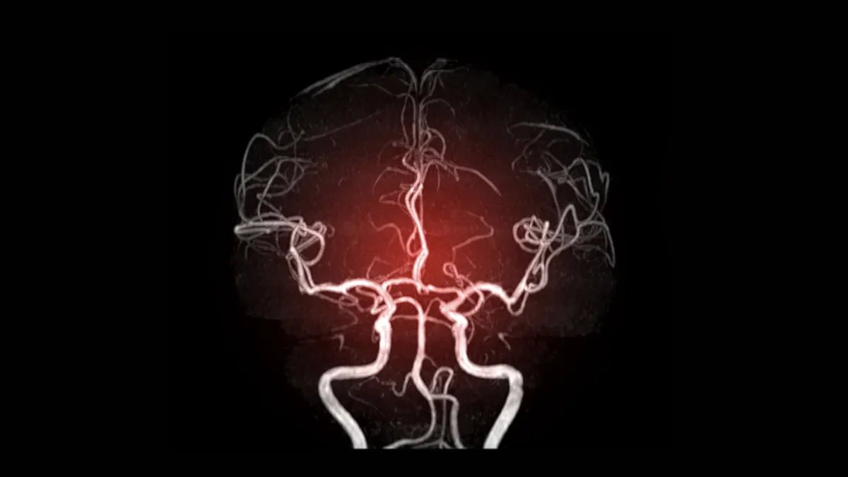 Cerebrálna venózna trombóza