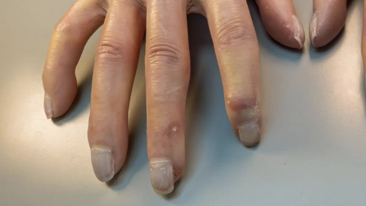 Sklerodermia (Systémová sklerodermia)