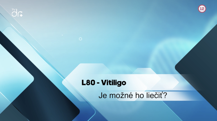 L80 Vitiligo
